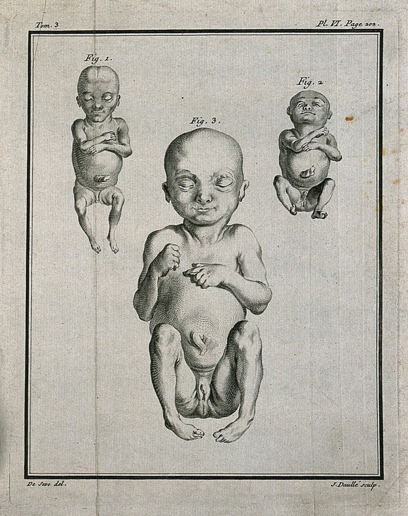 Three figures of foetuses with hermaphroditic genitals. 