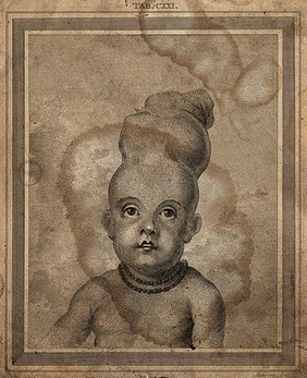 A child with two skulls joined together at the vertex. Engraving by J. Basire.