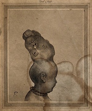 view A child with two skulls joined together at the vertex, seen from the right. Engraving by J. Basire.