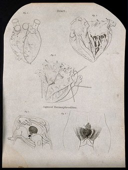 Heart: three figures, and the genital area of supposed hermaphrodites: two figures. Line engraving by Campbell, 1816/1821.