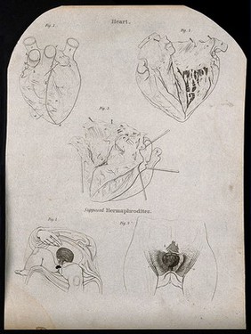 Heart: three figures, and the genital area of supposed intersex people: two figures. Line engraving by Campbell, 1816/1821.