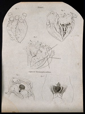 view Heart: three figures, and the genital area of supposed intersex people: two figures. Line engraving by Campbell, 1816/1821.