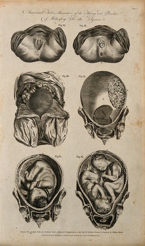 view Female genitalia and uterus during pregnancy: six figures, including cross-sections of foetus and twins in utero. Line engraving, 1790(?), by W. Taylor after F. Birnie after W. Smellie.