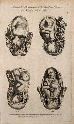 view Foetuses in utero: four figures showing cross-sections of a foetus in various positions in the uterus. Line engraving, 1791, by W. Taylor after F. Birnie, after W. Smellie.