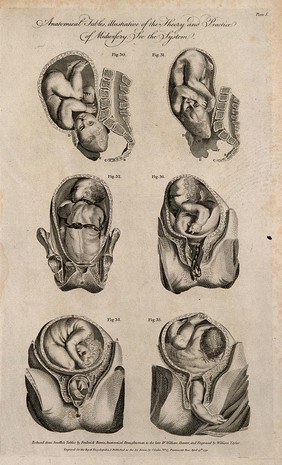 Foetuses in utero: six figures showing cross-sections of foetuses in various positions in the uterus prior to and during birth. Line engraving by W. Taylor, 1791, after F. Birnie after Smellie.