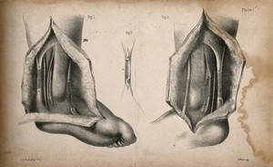 view Tendons of the ankle: three figures of a dissection. Lithograph by G.H. Ford after W.A., 1850/1870?.