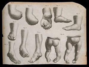 view Deformed feet and ankles: 10 figures. Line and stipple engraving, 1770/1830?.