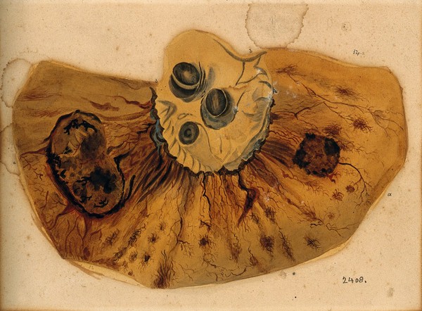 A section of diseased intestine or heart. Watercolour, 18--, after F. R. Say for Richard Bright, 1827.