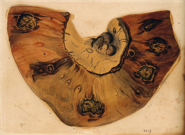 A section of diseased intestine. Watercolour, 18--, after F. R. Say for Richard Bright, 1827.