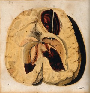 view A diseased brain. Watercolour, 18--, after F. R. Say for Richard Bright, 1827.