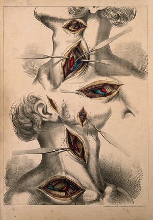 view Surgery of carotid and subclavian arteries: two figures showing incisions in the head and neck, with surgical instruments indicating arteries. Coloured lithograph by G.E. Madeley after A. A. Cane, 1834.