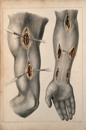 Surgery of the arteries of the arm: two figures showing incisions in the upper and lower arm, with surgical instruments indicating arteries. Coloured lithograph by G.E. Madeley after A. A. Cane, 1834.