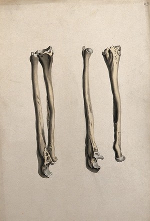 view Radius and ulna bones: two figures. Ink and watercolour, 1830/1835?, after W. Cheselden, ca. 1733.