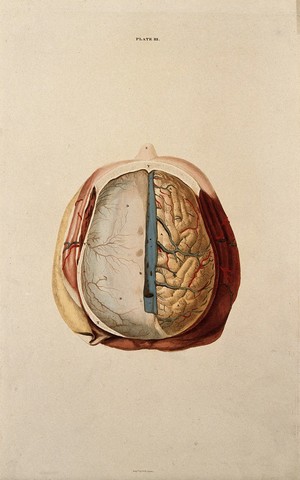 view Brain: dissection showing the top of the brain, with the dura mater of the left hemisphere and the gyri of the right. Coloured line engraving by W.H. Lizars, ca. 1827.