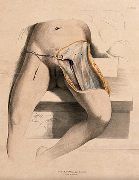 A dissection of the groin. Coloured lithograph by A. Morton, 1839.