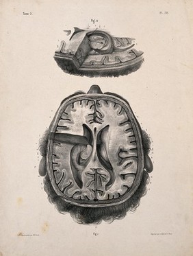 The brain: two figures of a section through a head and brain, showing the lateral ventricles and third ventricle. Lithograph by N.H Jacob, 1831/1854.