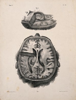 view The brain: two figures of a section through a head and brain, showing the lateral ventricles and third ventricle. Lithograph by N.H Jacob, 1831/1854.