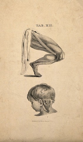 Lower limb: écorché leg showing the sartorial muscle, and a partial dissection of the back of a young child's neck. Lithograph, 1825/1845(?).