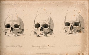 view Human skulls: three figures showing the skulls of an African, a Native American and a Chinese. Stipple engraving, 1843.