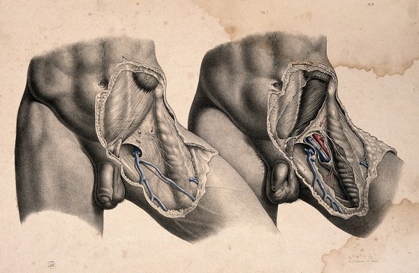 Dissection of the left groin of a man: two figures. Coloured lithograph by J. Maclise, 1851.