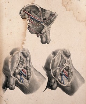 Dissection of the left groin of a man with hernia: three figures. Coloured lithograph by J. Maclise, 1851.