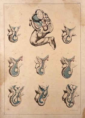 Congenital and infantile hernias: nine figures. Coloured lithograph by J. Maclise, 1851.