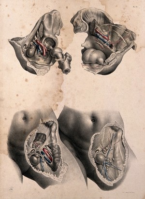 view Femoral hernia: four figures. Coloured lithograph by J. Maclise, 1851.