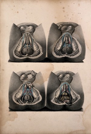 view Dissection of the perinaeum of a man: four figures. Coloured lithograph by J. Maclise, 1851.