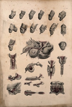 Surgery and deformities of the prepuce and the urethra of a man. Coloured lithograph by J. Maclise, 1851.