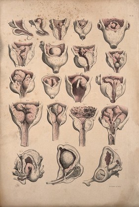 Surgery of the prostate gland. Coloured lithograph by J. Maclise, 1851.