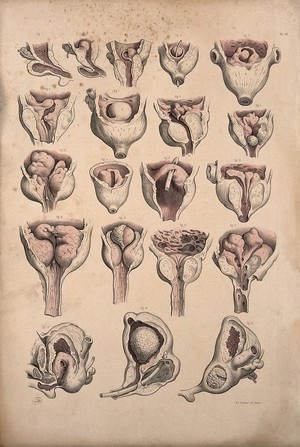view Surgery of the prostate gland. Coloured lithograph by J. Maclise, 1851.