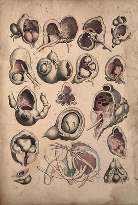 Surgery of the bladder of a man: seventeen figures. Coloured lithograph by J. Maclise, 1851.