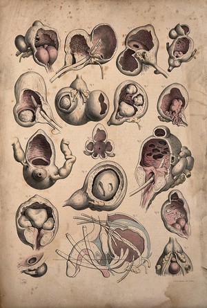 view Surgery of the bladder of a man: seventeen figures. Coloured lithograph by J. Maclise, 1851.