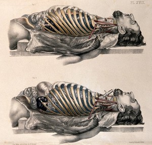 view The body of a man lying down with the trunk dissected: two figures showing the lungs after breathing out (above) and after breathing in (below, simulated by inflating the lungs). Coloured lithograph by William Fairland, 1869.