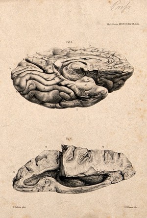 view Brain of an African Bushwoman: two figures, each of a section of the brain. Lithograph by E.M. Williams after H. Watkins, 1864.