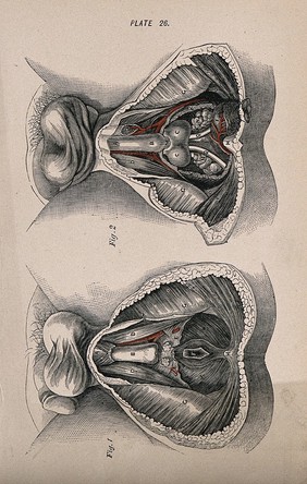 Dissections of the male genital and rectal area: two figures. Coloured wood engraving with letterpress, 1860/1900?.