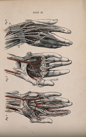 Dissection of the hand and fingers: three figures, showing the tendons and blood vessels. Colour wood engraving with letterpress, 1860/1900?.