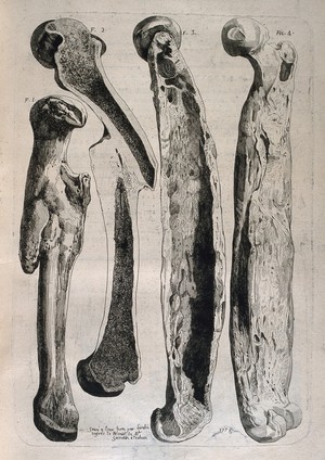 view Diseased and broken femur bones: four figures. Etching by Lavalée after J. Gamelin, 1778.