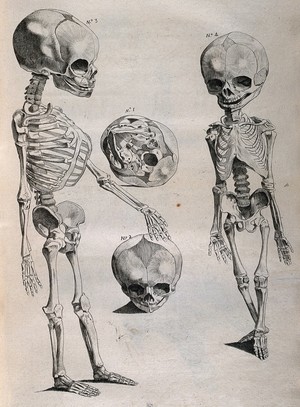 view Foetal skeletons: front and side views, with two details showing skulls. Etching by or after J. Gamelin, 1778/1779.