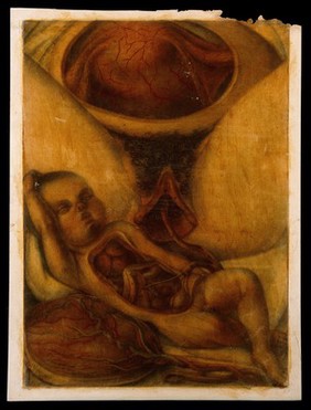 Dissection of a foetus and the womb of the mother, shortly after birth. Colour mezzotint by J. F. Gautier d'Agoty after himself, 1754.