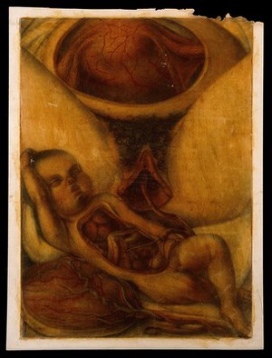 view Dissection of a foetus and the womb of the mother, shortly after birth. Colour mezzotint by J. F. Gautier d'Agoty after himself, 1754.