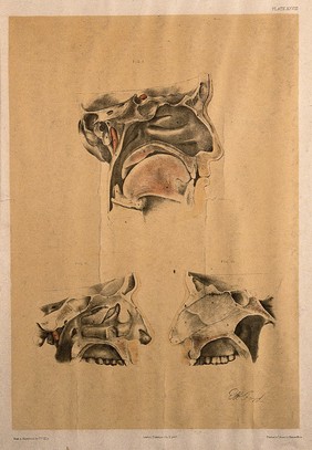 Dissections of the upper jaw and the sinuses (?): three figures. Colour lithograph by G.H. Ford, 1865.