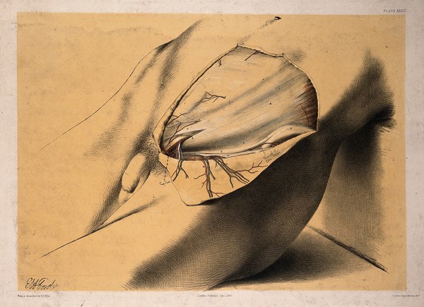 Dissection of the groin and lower abdomen of a man, with the muscles and blood vessels indicated. Colour lithograph by G.H. Ford, 1865.