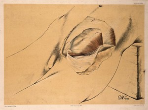 view Dissection of the groin and lower abdomen of a man, with the muscles and blood vessels indicated. Colour lithograph by G.H. Ford, 1865.