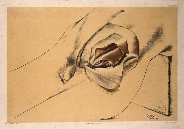 Dissection of the groin and lower abdomen of a man, with the muscles and blood vessels indicated. Colour lithograph by G.H. Ford, 1865.