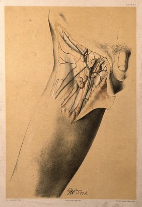 Dissection of the groin and upper thigh of a man, showing the blood vessels, veins and lymph nodes (?). Colour lithograph by G.H. Ford, 1866.