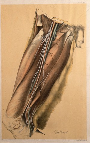 view Dissection of the thigh of a man, showing the muscles, arteries, veins and blood vessels. Colour lithograph by G.H. Ford, 1866.