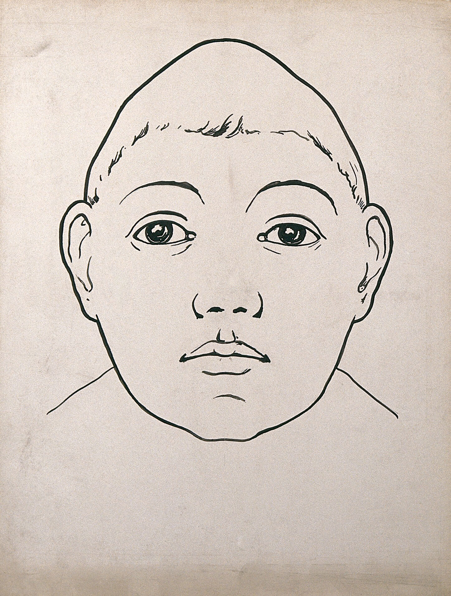 Child S Head With Large Temporal Lobes And Depressed Frontal Lobe
