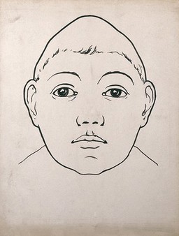 Child's head with large temporal lobes and depressed frontal lobe. Drawing, c. 1900.