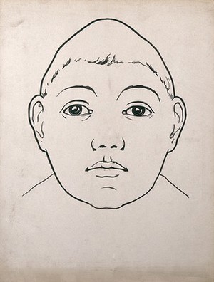 view Child's head with large temporal lobes and depressed frontal lobe. Drawing, c. 1900.